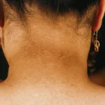 hp-neck-tanning-removal-treatmentjpgsuummpeqe.jpg