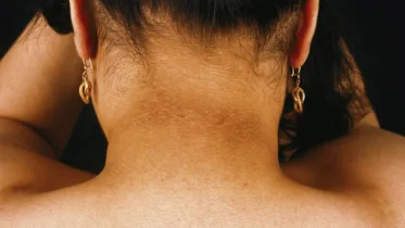 Black Neck: કાળી ડોકને સાફ કરવા માટે સરળ ટીપ્સ